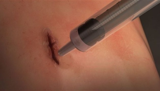 Ученые создали мгновенный клей, заживляющий раны без швов и скоб Ученые создали мгновенный клей, заживляющий раны без швов и скоб