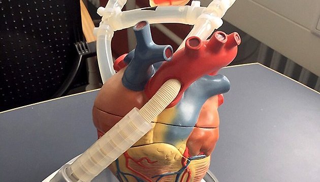 “我们做到了”：乌克兰医生首次成功植入人工心脏