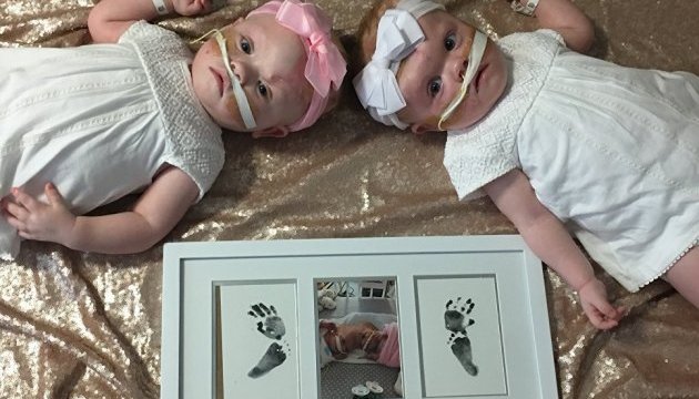 Хірурги у США провели унікальну операцію з розділення сіамських близнюків