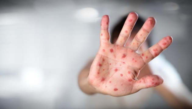 Health Ministry: 12 people die of measles in Ukraine since start of year