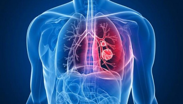 Рак легенів: причини, симптоми і лікування