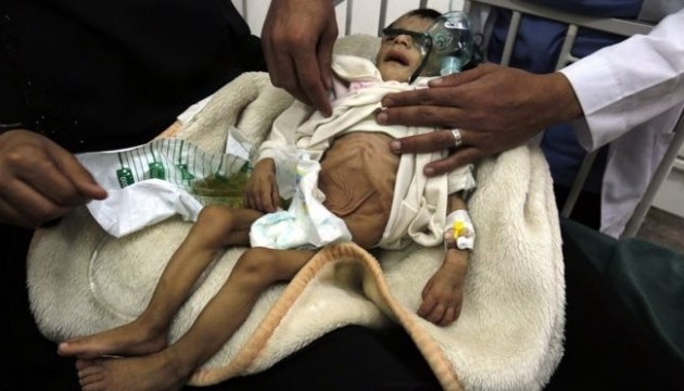 В ООН заявляють про масову загибель дітей від голоду та хвороб в Ємені