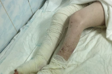 В інтернаті на Вінничині дитина отримала опіки через недбалість персоналу
