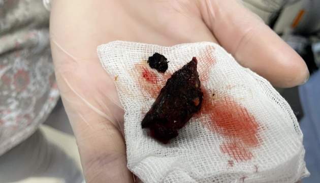  Уламок снаряда біля серця: львівські хірурги врятували підлітка з Бахмута