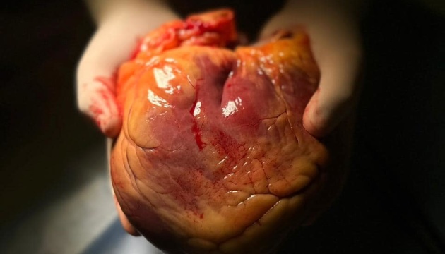 У Полтаві успішно провели трансплантацію серця