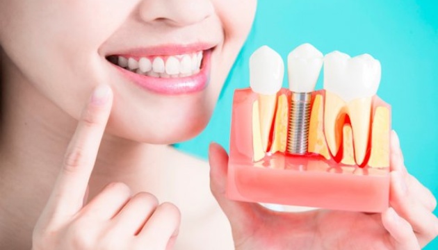 Імплантація зубів: поняття процедури та її переваги