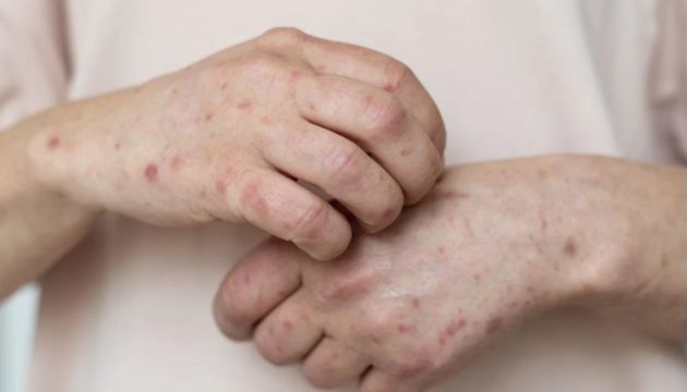 На Полтавщині - спалах кору