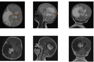 У Львові врятували двомісячне немовля з пухлиною в мозку