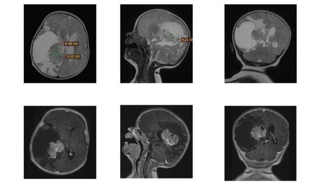 У Львові врятували двомісячне немовля з пухлиною в мозку