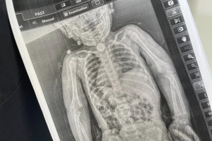 У Львові хірурги врятували дитину, яка декілька місяців жила з батарейкою у стравоході