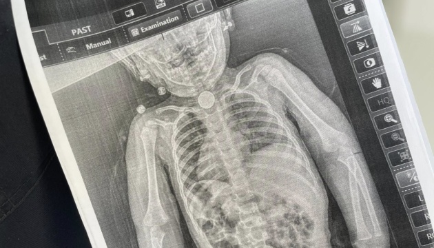 У Львові хірурги врятували дитину, яка декілька місяців жила з батарейкою у стравоході