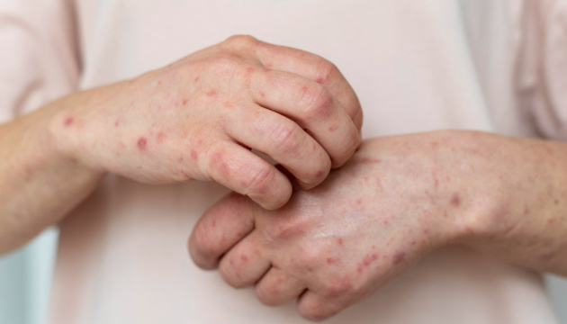 На Прикарпатті ліквідували п’ять спалахів кору